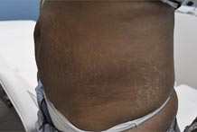 Ventre relâchement + vergetures/www.rajeunissment-esthetique.com