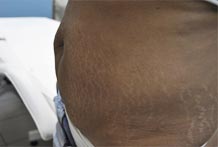 Ventre relâchement + vergetures/www.rajeunissment-esthetique.com