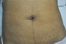 Ventre relâchement + vergetures/www.rajeunissment-esthetique.com